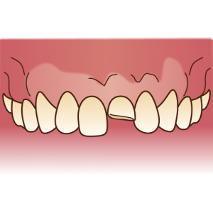 歯のブリッジについて おろしまち歯科医院 スタッフブログ 仙台市若林区の歯医者